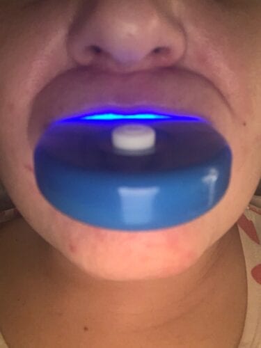 Holla Smile™ Teeth Whitening KIT photo review